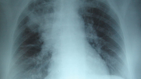 Radiografia al torace in un soggetto con fibrosi cistica