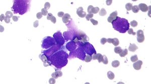 Cellule tumorali